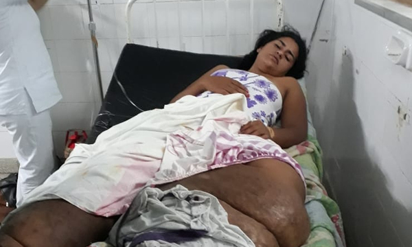 Joven quien sufre de elefantiasis apela a la solidaridad ciudadana – Prensa 5
