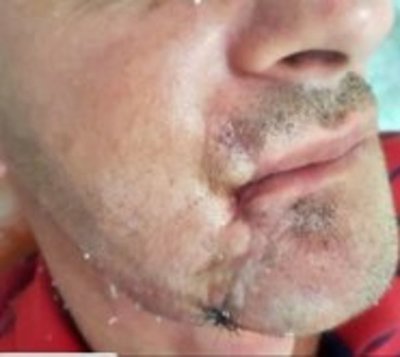 Hombre accede a primera cirugía maxilofacial en Hospital del Trauma - Paraguay.com