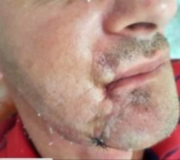Hombre accede a primera cirugía maxilofacial en Hospital del Trauma - Paraguay.com