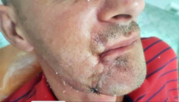 INÉDITO: RECONSTRUYEN LA MANDÍBULA DE UN HOMBRE, CON IMPLANTE IMPRESO EN 3D
