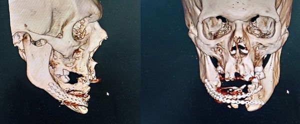Realizan primera cirugía maxilofacial en 3D