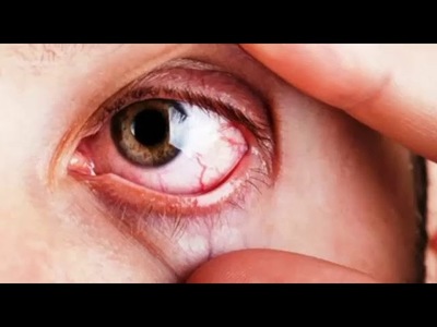 Glaucoma, la enfermedad silenciosa que puede dejarte ciego