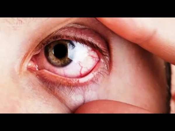 Glaucoma, la enfermedad silenciosa que puede dejarte ciego