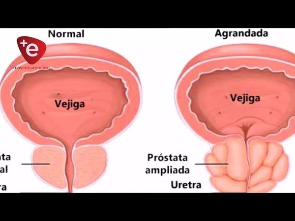 AGRANDAMIENTO DE LA PRÓSTATA: ES NORMAL EN ADULTOS MAYORES Y NO ES UN CÁNCER