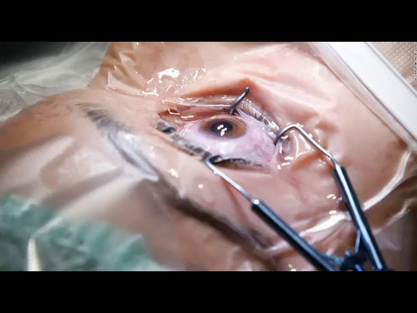 REALIZAN PRIMER TRASPLANTE DE RETINA EN PARAGUAY