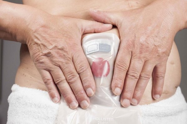 Preocupante aumento de casos de cáncer de colon - Nacionales - ABC Color