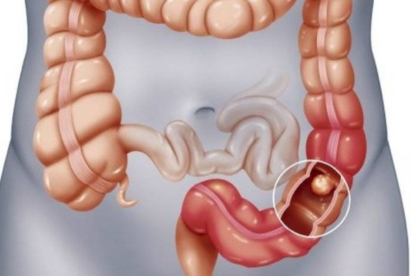 HOY / Cáncer de colon: dieta puramente cárnica propicia su aparición