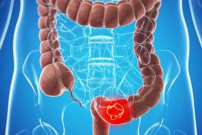 Cáncer de colon: controles de rutina son fundamentales, indica especialista