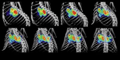 Desarrollan un fármaco que bloquea un gen clave en cáncer - Ciencia - ABC Color
