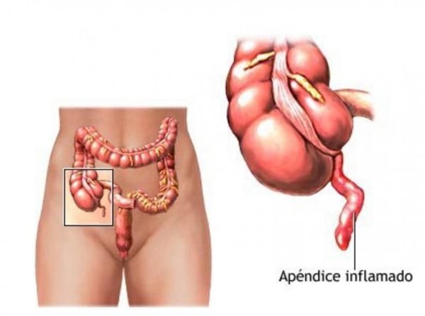 ¿Apendicitis aguda? | Paraguay en Noticias