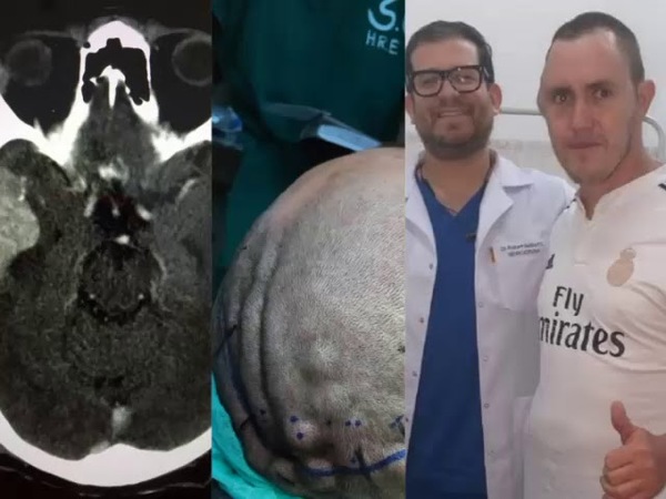 HISTÓRICA CIRUGÍA DE TUMOR CEREBRAL EN EL HOSPITAL REGIONAL DE ENCARNACIÓN