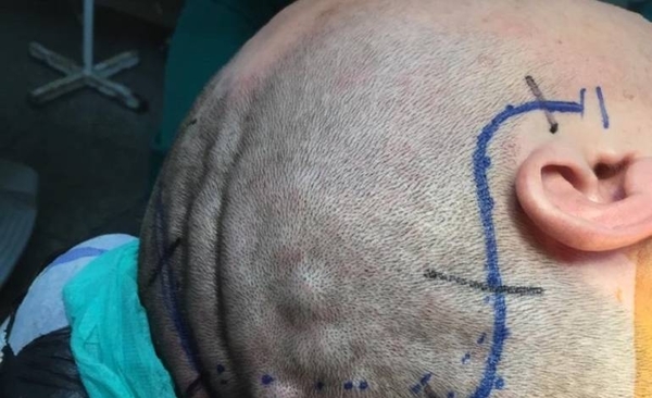 HOY / Exitosa cirugía de tumor cerebral: consultó por dolores de cabeza y terminó en el quirófano