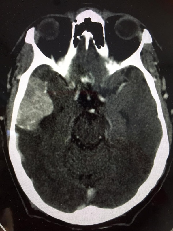 Reportan primera cirugía de tumor cerebral en Hospital Regional de Encarnación » Ñanduti