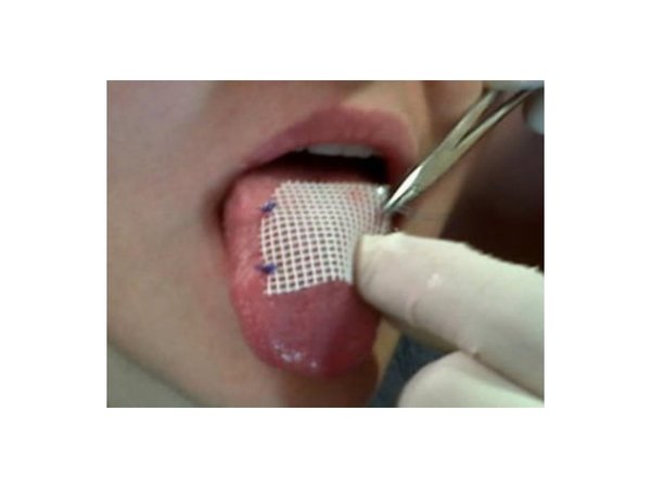 Recurren al parche en la lengua para bajar de peso