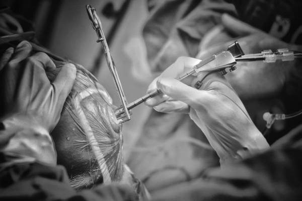 EXTRAEN TUMOR CEREBRAL CON NEUROENDOSCOPÍA EN EL HOSPITAL DE CLÍNICAS