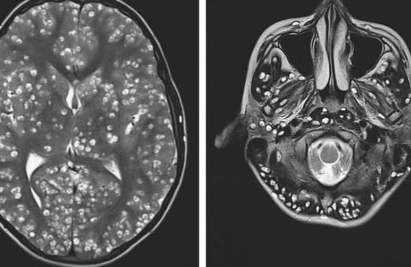 Joven murió por larvas que invadieron su cerebro tras comer cerdo mal cocinado - C9N