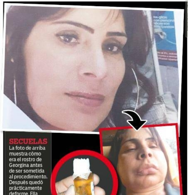 El día que una farsante inyectó silicona de ferretería a mujer y le desfiguró el rostro
| Paraguay en Noticias