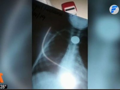 Niña de tres años tragó una moneda