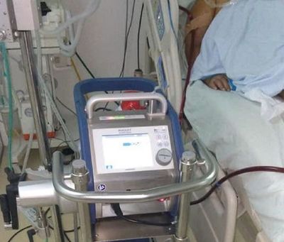 Paciente adulta es conectada con éxito al “pulmón artificial”
