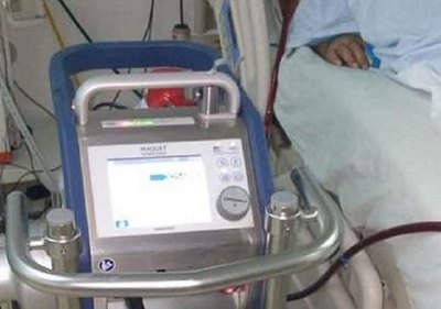 Primera paciente con un pulmón artificial