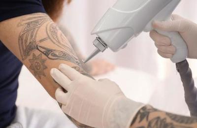Nueva técnica permite eliminar los tatuajes sin dolor - C9N