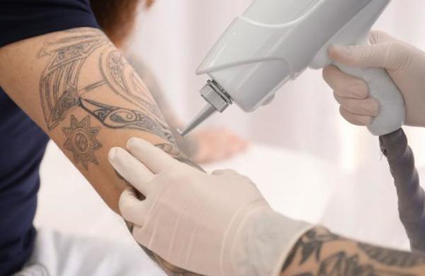 Nueva técnica permite eliminar los tatuajes sin dolor - C9N