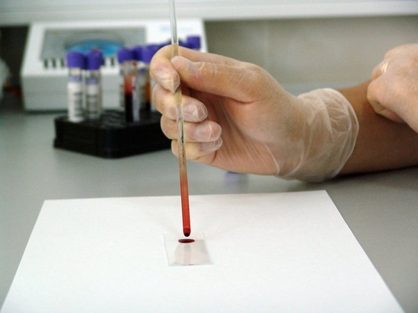 Prueba de sangre permite conocer evolución del cáncer de mama