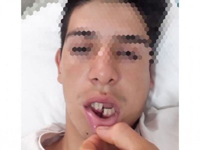 Le reventó la mandíbula porque réfere no cobró falta