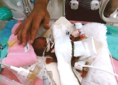 El “bebé más pequeño del mundo” saldrá del hospital