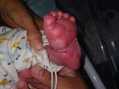Recién nacido sufrió quemaduras en un hospital
