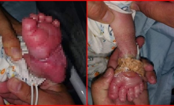 Negligencia en hospital causó graves quemaduras en recién nacido