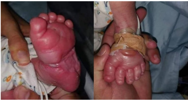HOY / Bebé sufre quemaduras en hospital de San Ignacion, el padre acusa negligencia