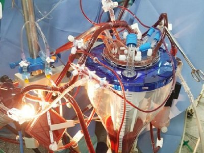 Aplican innovadora técnica  en  una cirugía cardiaca compleja