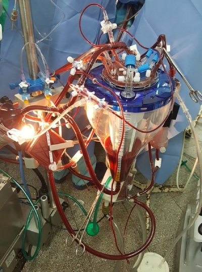 Cirugía cardiaca compleja con innovadora técnica - ADN Paraguayo