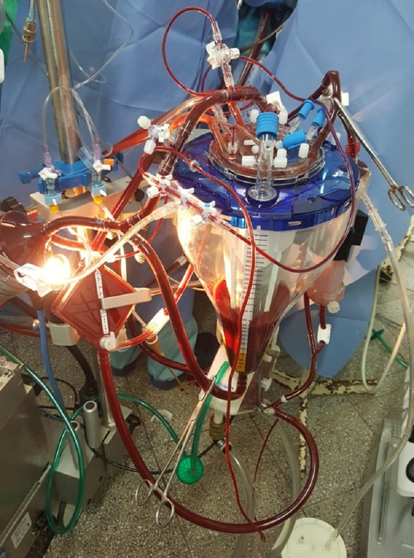 Cirugía cardiaca compleja con innovadora técnica - ADN Paraguayo