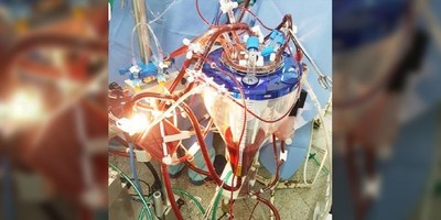 APLICAN INNOVADORA TÉCNICA EN UNA CIRUGÍA CARDÍACA COMPLEJA