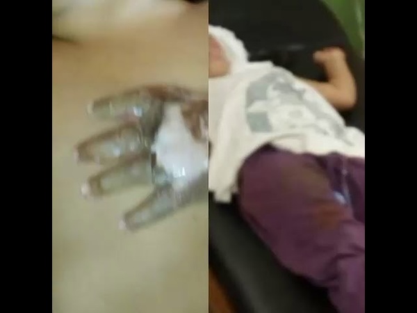 SE LES CAYÓ SARTÉN CON ACEITE CALIENTE Y SUFREN QUEMADURAS