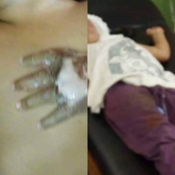 MA. AUXILIADORA: DOS BEBÉS SUFREN QUEMADURAS GRAVES CON ACEITE HIRVIENDO