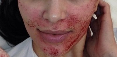 Contrajeron VIH por ¡“facial del vampiro”!