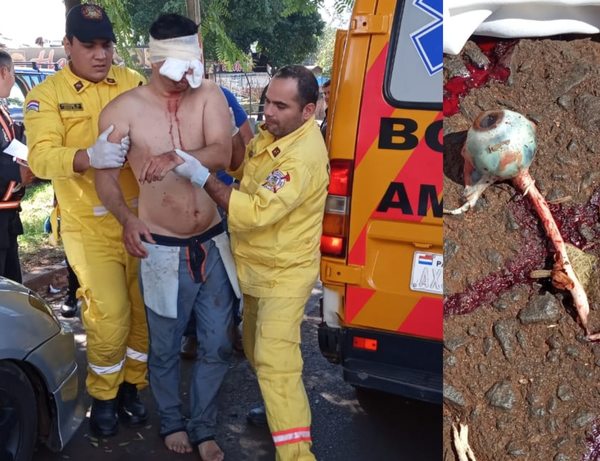 Brasileño dopado se quitó un ojo con el dedo