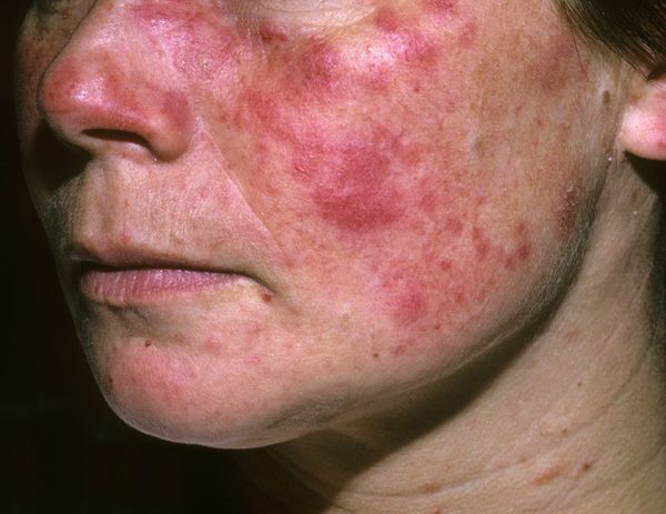 El Día Mundial del Lupus en el Hospital de Clínicas » Ñanduti