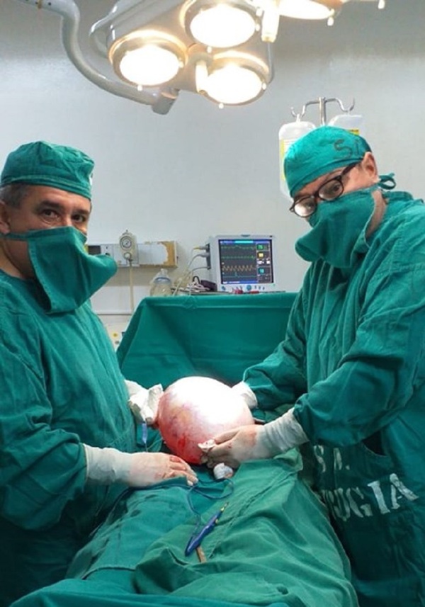 Extirpan con éxito tumor de 6 kilos en Hospital Regional de Cnel. Oviedo - ADN Paraguayo