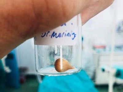 Semilla de mandarina casi asfixió a un bebé
