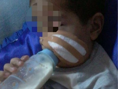 Perro destrozó la cara de un nenito