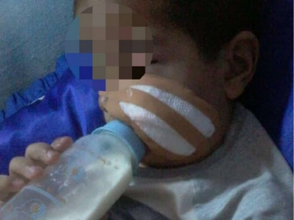 Perro destrozó la cara de un nenito
