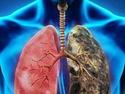 Inmunoterapia reduce riesgos en cáncer de pulmón con metástasis de hígado