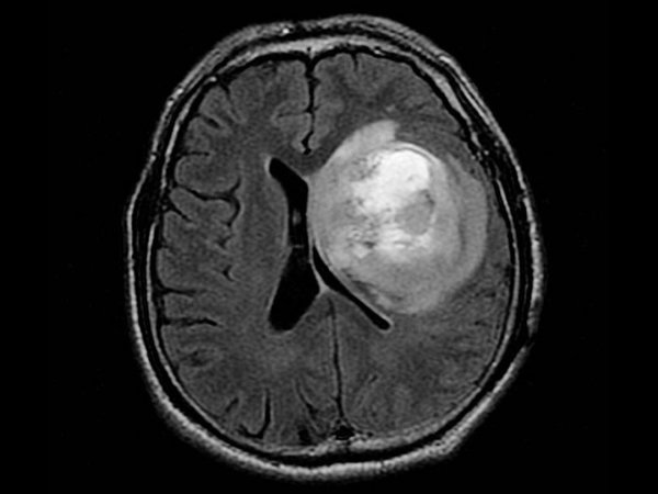 Hallan nuevas combinaciones de fármacos contra el glioblastoma en ratones
