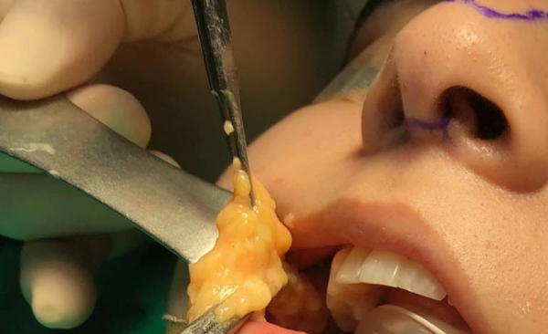 HOY / Bichectomía: la cirugía para 'arreglar' la cara y que puede paralizar el rostro, o matar