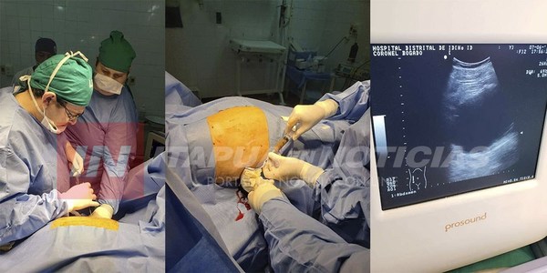 EXTRAEN QUISTE GIGANTE EN EL HOSPITAL DE CORONEL BOGADO.