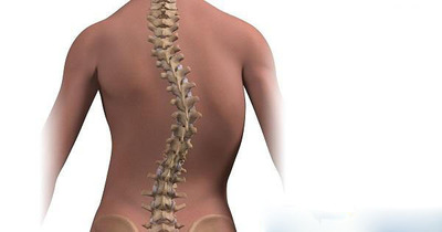 Escoliosis, detección precoz es clave - ADN Paraguayo